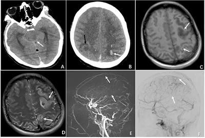 Cerebral venous thrombosis as a rare cause of nausea and vomiting in early pregnancy: Case series in a single referral center and literature review